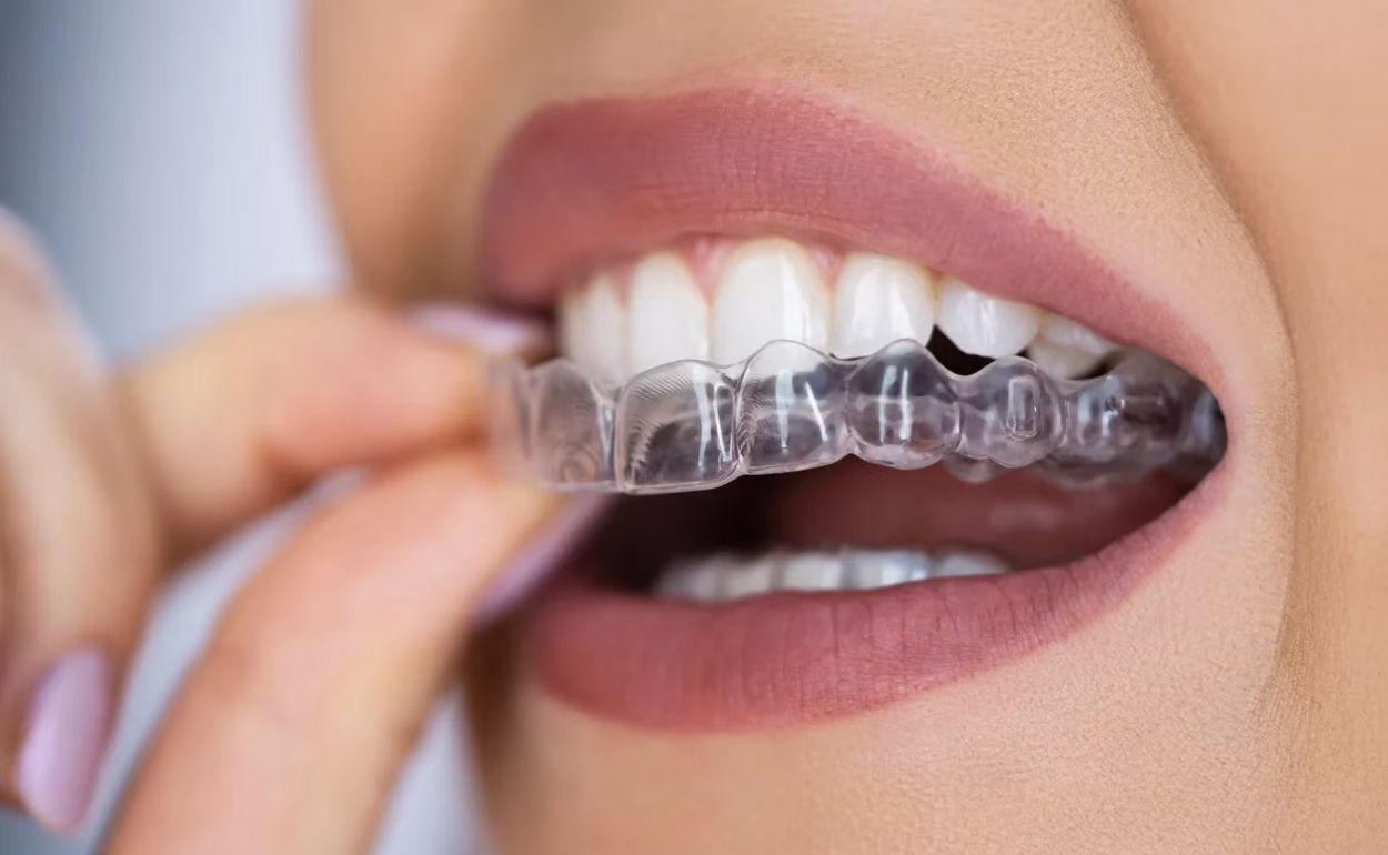 Invisalign & Clear Aligners
