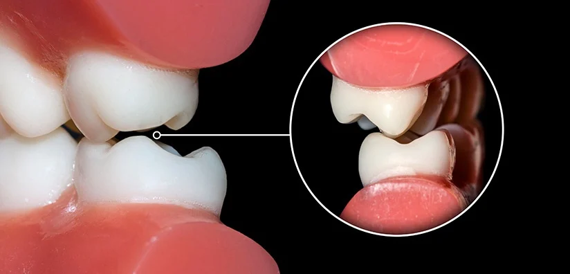 Occlusal Reconstruction in Dubai