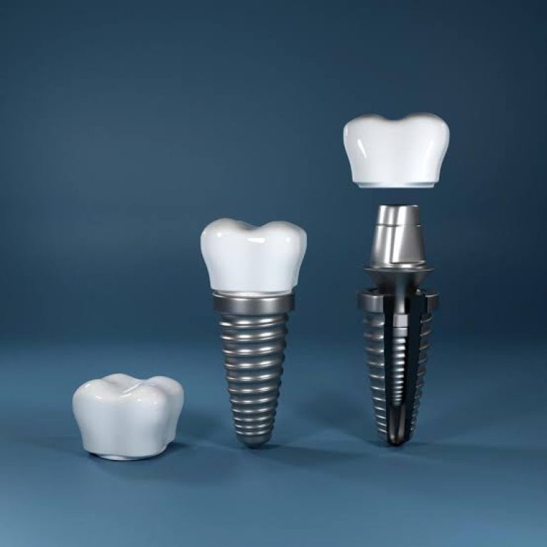 Dental Implants vs Bridges Dubai
