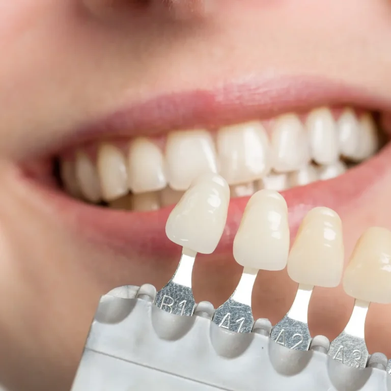 Porcelain Veneers
