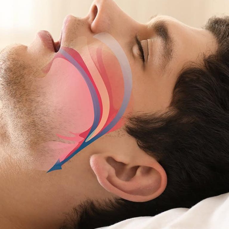 Snoring Treatment Dubai