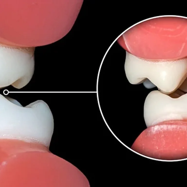 Occlusal Reconstruction in Dubai